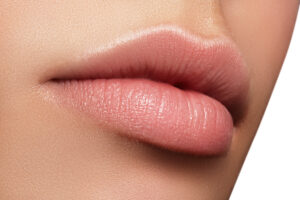 Patient after lip augment