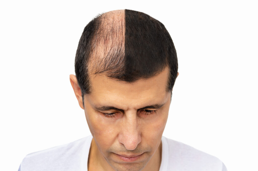 While recovery times can vary, both procedures generally require a few days to a week of downtime, with most patients resuming normal activities shortly after.