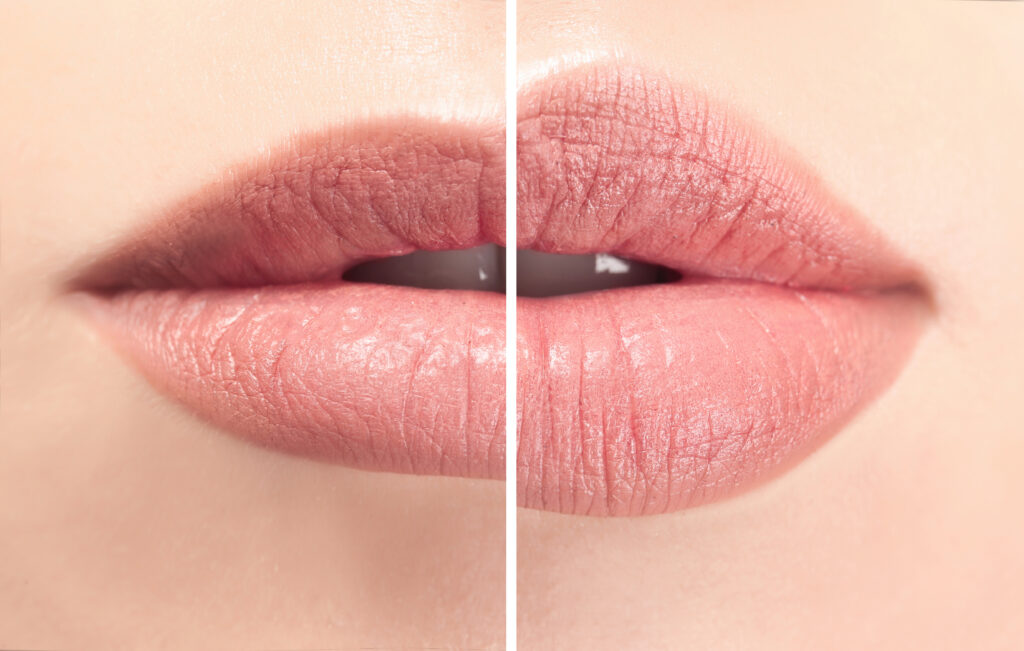 Lip Enhancement is a non-invasive procedure that can be done in Naples, FL from Dr. Anurag Agarwal. 