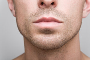 Dr. Anurag Agarwal provides life changing results for its patients with a Men Cheek and Chin Implants.