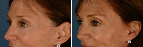 Cutera Excel V Laser Before and After Photos in Naples, FL, Patient 24123