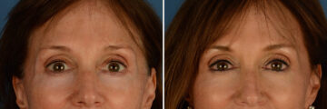 Cutera Excel V Laser Before and After Photos in Naples, FL, Patient 24123