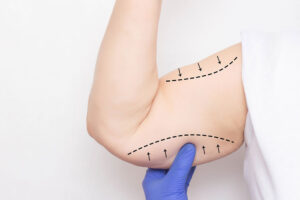 Arm lifts, also known as brachioplasty, remove excess skin and fat from the upper arms.