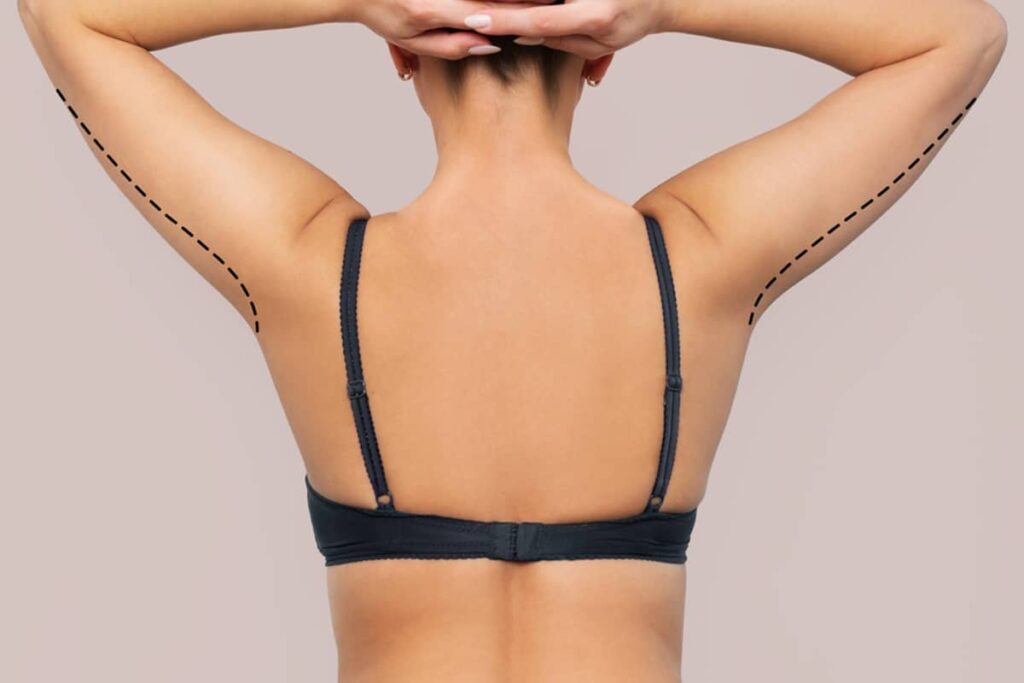 Applying silicone gel to the arm lift scar can help reduce redness and improve the appearance of the scar.