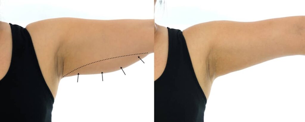 With proper care, the scars associated with brachioplasty are often minimal and fade over time, making it a worthwhile procedure for many patients.