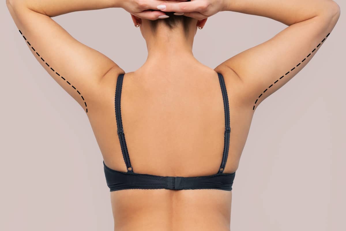 Brachioplasty Scars What to Expect and How to Manage Them
