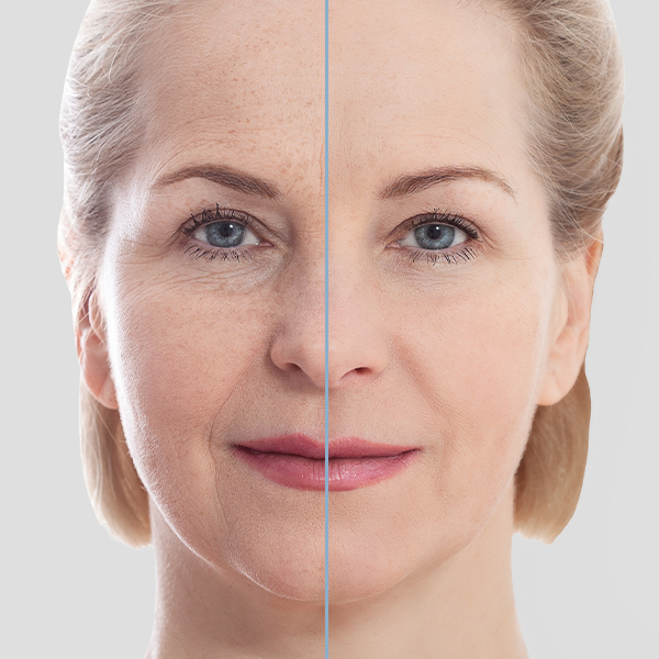  The blepharoplasty procedure is typically performed under anesthesia and is completely safe with a quick and smooth recovery.