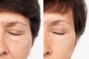 Before and after a blepharoplasty procedure with minimal, noticeable scars.