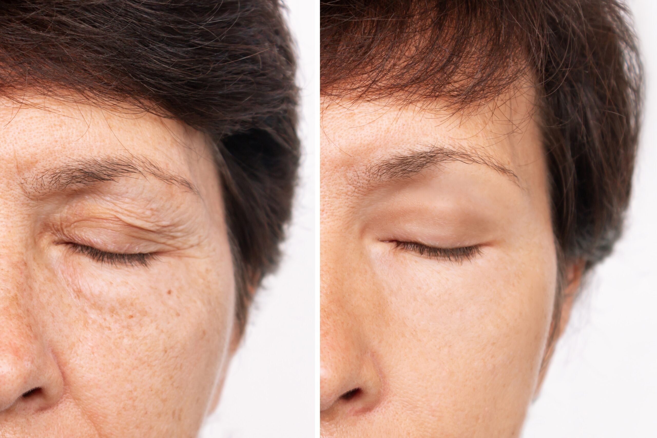 Before and after a blepharoplasty procedure with minimal, noticeable scars.