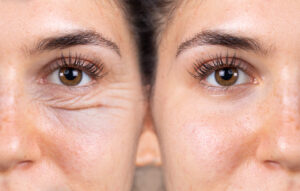 Reduce Blepharoplasty Eyelid Surgery scars with Dr. Anurag Agarwal tips in Naples, FL.