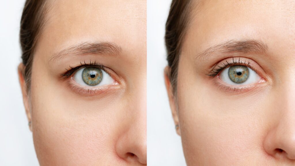 Dr. Anurag expertise brings a guide for dealing with blepharoplasty scars