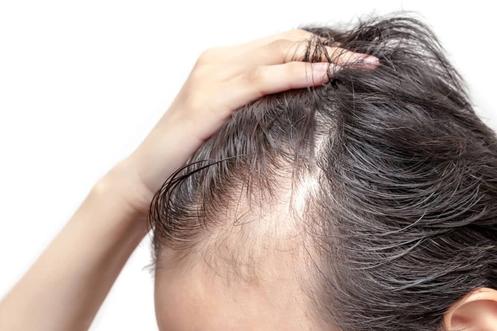 The recovery time after a hair transplant is relatively short, with most patients returning to their normal activities within a week.