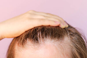 Hair transplants involve the removal of healthy hair follicles from one area of the scalp and implanting them into areas where hair loss has occurred.