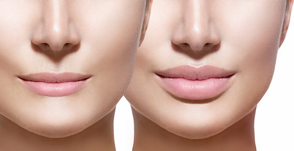 Lip Augmentation can improve your image, but a smooth recovery is key for a good experience.