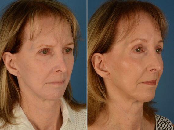 Eyebrow & Forehead Before and After Photos in Naples, FL, Patient 24254