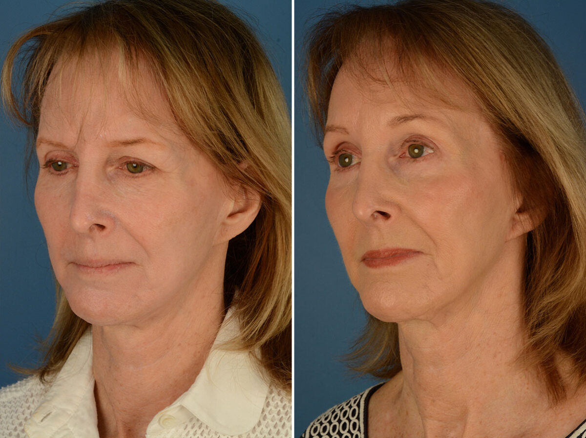 Eyebrow & Forehead Before and After Photos in Naples, FL, Patient 24254