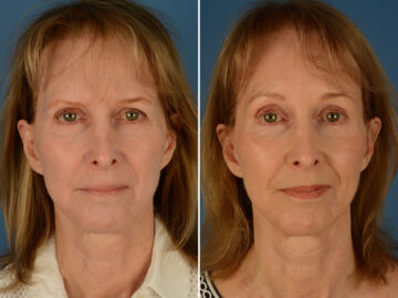 Eyebrow & Forehead Before and After Photos in Naples, FL, Patient 24254