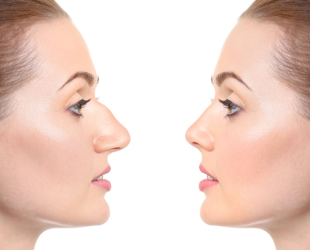 Rhinoplasty provided by Dr. Anurag Agarwal in Naples, FL