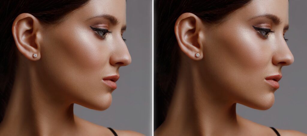 Proper care post-rhinoplasty accelerates recovery