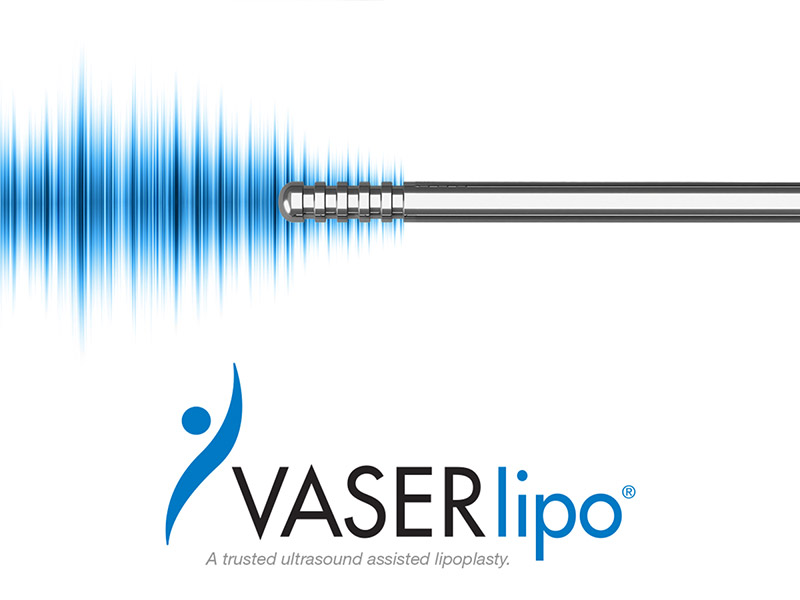 VASER® Liposuction