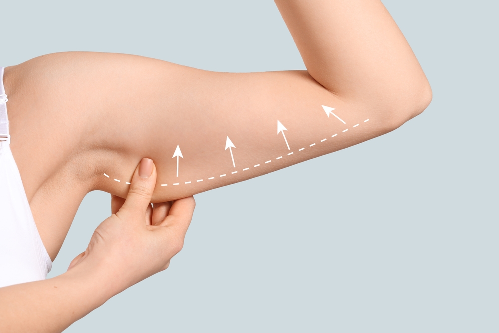 Dr. Anurag's objective is making an outstanding procedure with no visible scarring after a fully healed arm lift.