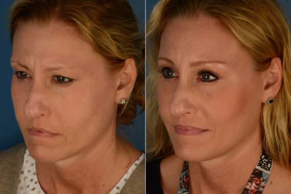 Eyebrow & Forehead Before and After Photos in Naples, FL, Patient 19732