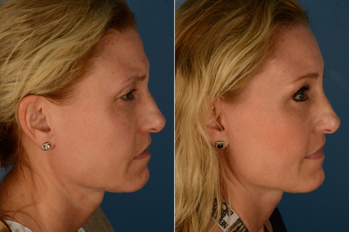 Eyebrow & Forehead Before and After Photos in Naples, FL, Patient 19732