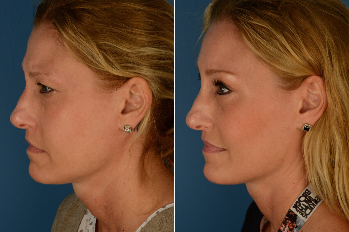 Eyebrow & Forehead Before and After Photos in Naples, FL, Patient 19732