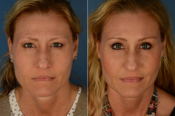 Eyebrow & Forehead Before and After Photos in Naples, FL, Patient 19732