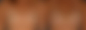 Breast Augmentation Before and After Photos in Naples, FL, Patient 23945