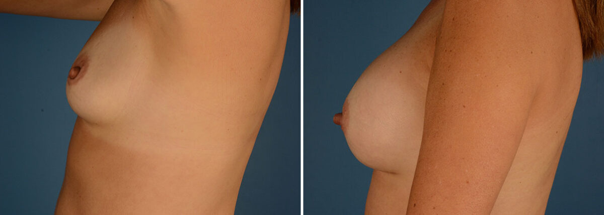 Breast Augmentation Before and After Photos in Naples, FL, Patient 23945