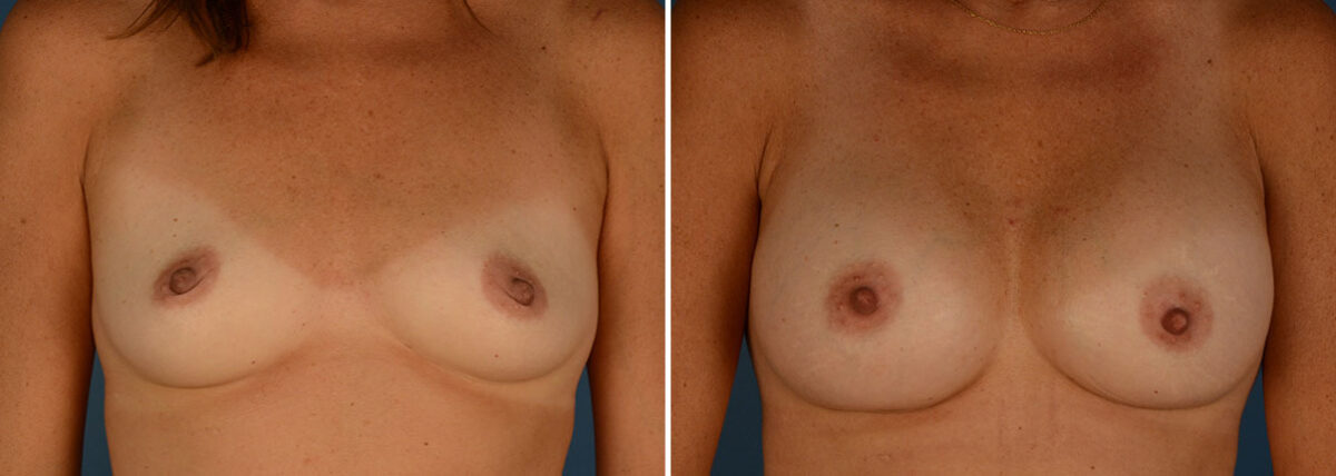 Breast Augmentation Before and After Photos in Naples, FL, Patient 23945