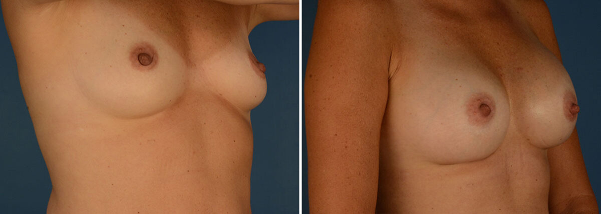 Breast Augmentation Before and After Photos in Naples, FL, Patient 23945