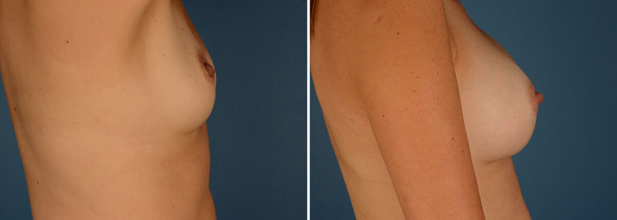 Breast Augmentation Before and After Photos in Naples, FL, Patient 23945
