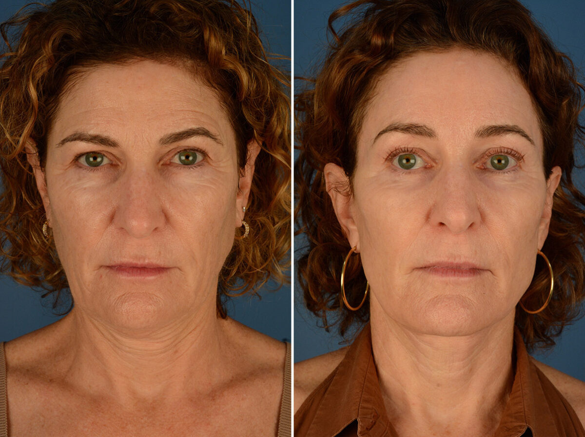 The UpLift™ Lower Face and Neck Lift Before and After Photos in Naples, FL, Patient 24422
