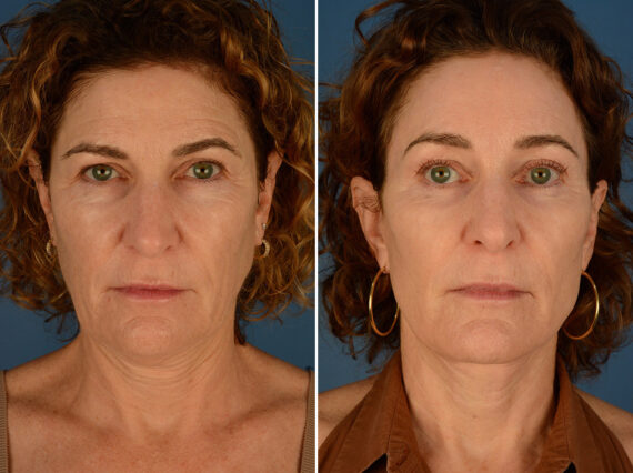The UpLift™ Lower Face and Neck Lift Before and After Photos in Naples, FL, Patient 24422