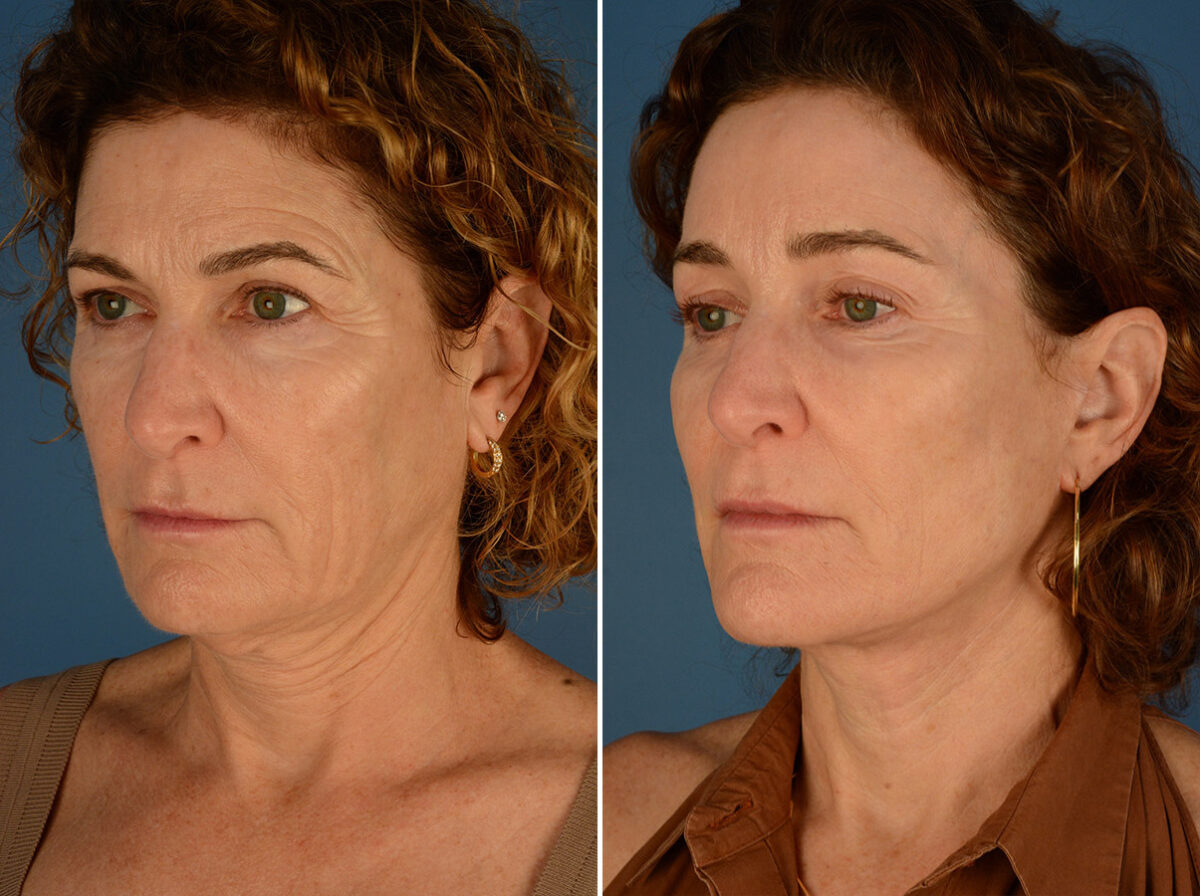 The UpLift™ Lower Face and Neck Lift Before and After Photos in Naples, FL, Patient 24422