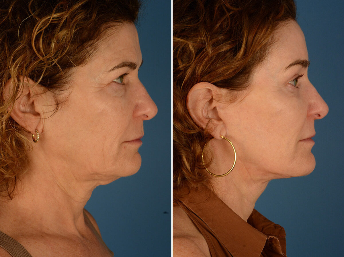 The UpLift™ Lower Face and Neck Lift Before and After Photos in Naples, FL, Patient 24422