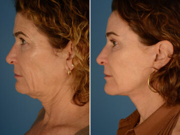 The UpLift™ Lower Face and Neck Lift Before and After Photos in Naples, FL, Patient 24422