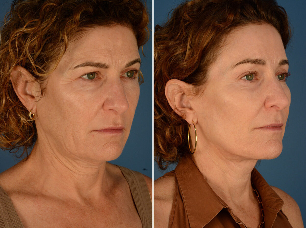 The UpLift™ Lower Face and Neck Lift Before and After Photos in Naples, FL, Patient 24422