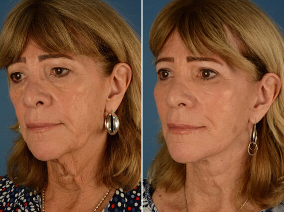 Endoscopic Facelift Before and After Photos in Naples, FL, Patient 24438