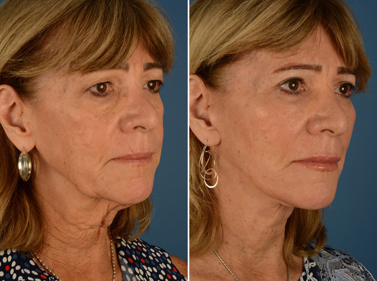 Endoscopic Facelift Before and After Photos in Naples, FL, Patient 24438