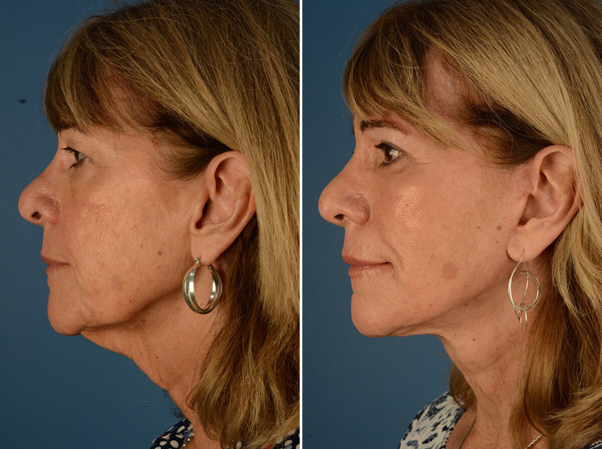 Endoscopic Facelift Before and After Photos in Naples, FL, Patient 24438