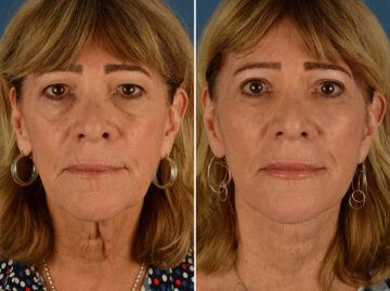 Endoscopic Facelift Before and After Photos in Naples, FL, Patient 24438