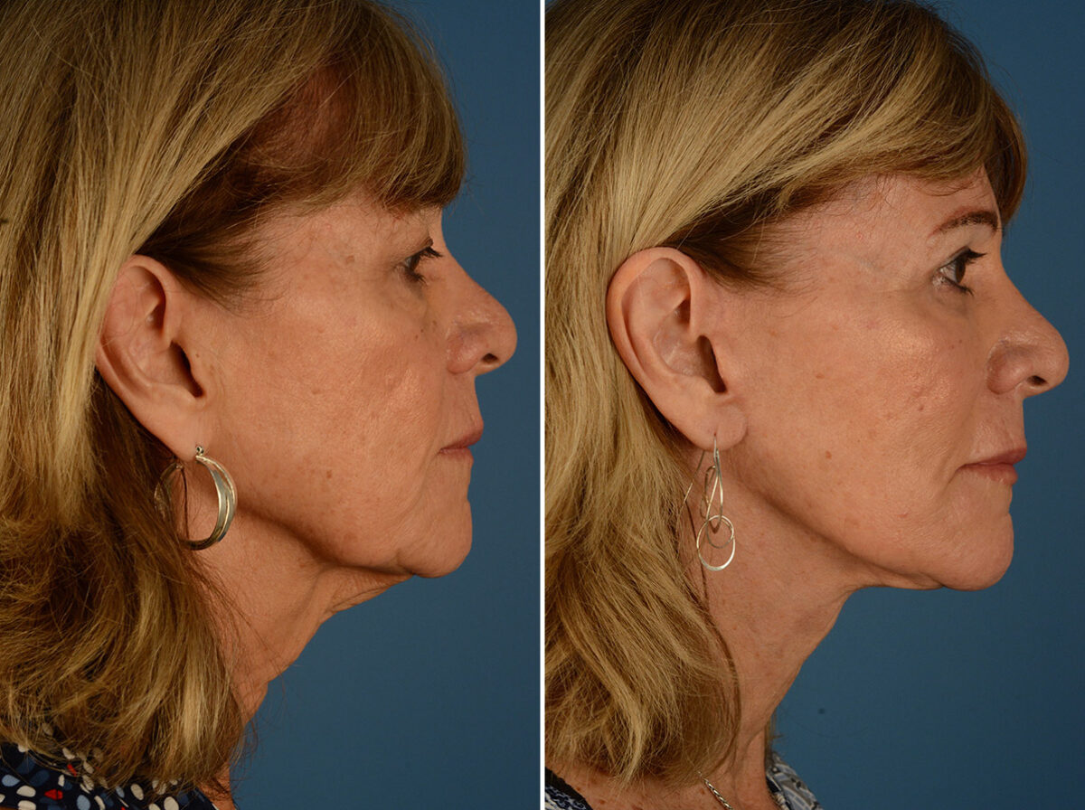 Endoscopic Facelift Before and After Photos in Naples, FL, Patient 24438