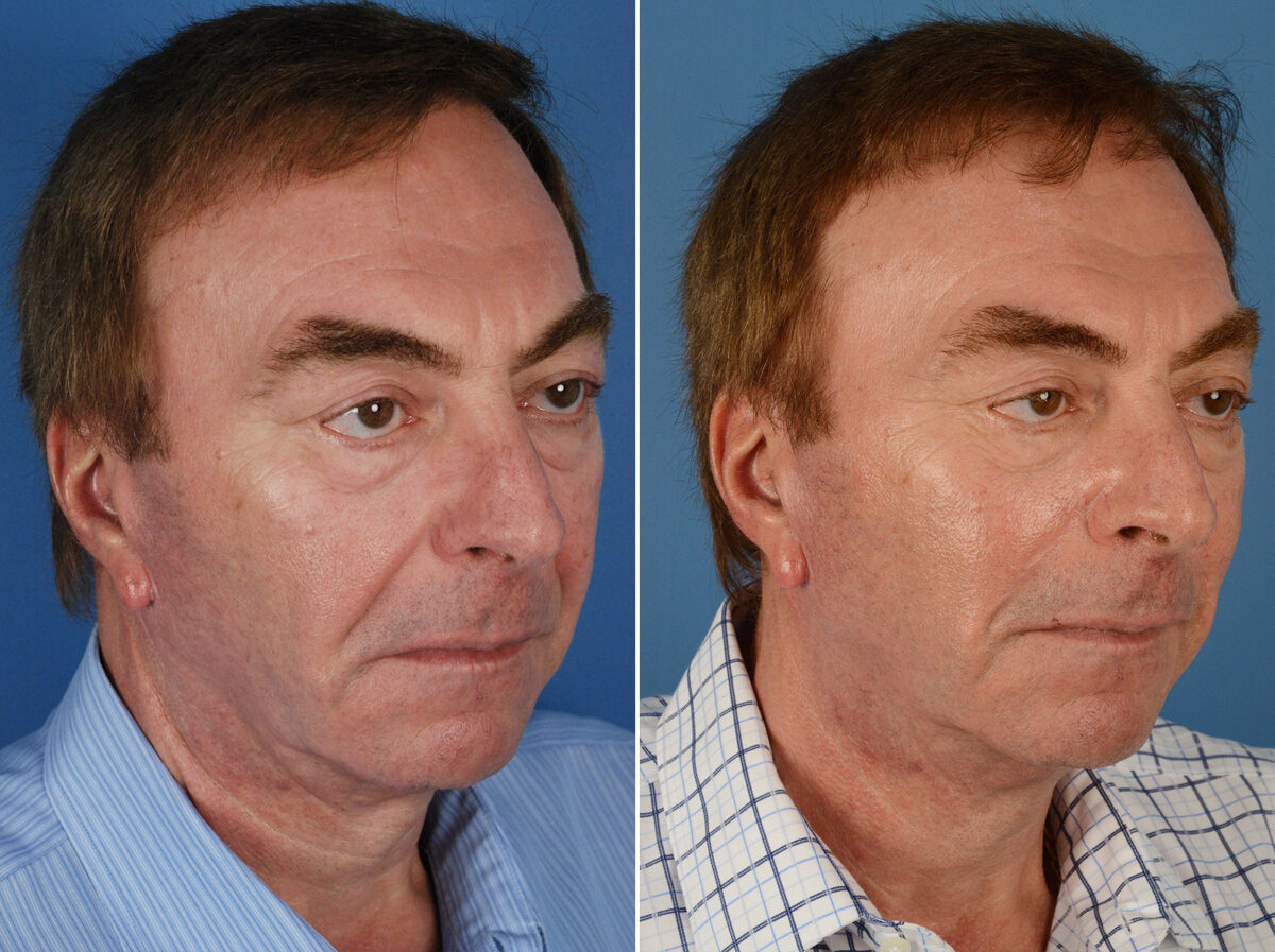 Excision of Nasolabial Folds Male Before and After Photos in Naples, FL, Patient 12012