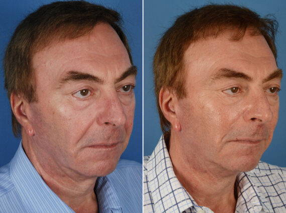 Excision of Nasolabial Folds Male Before and After Photos in Naples, FL, Patient 12012