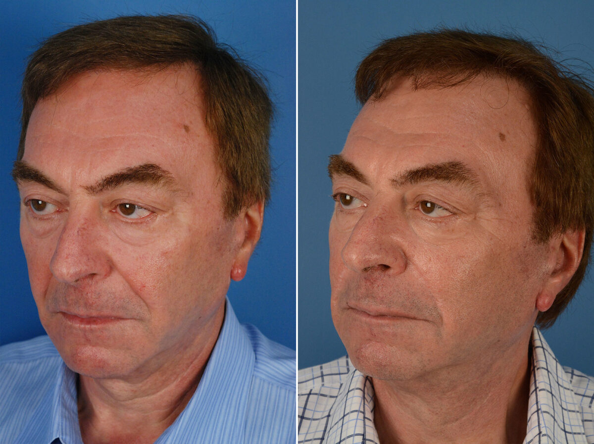 Excision of Nasolabial Folds Male Before and After Photos in Naples, FL, Patient 12012