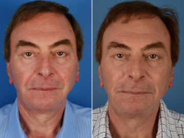 Excision of Nasolabial Folds Male Before and After Photos in Naples, FL, Patient 12012