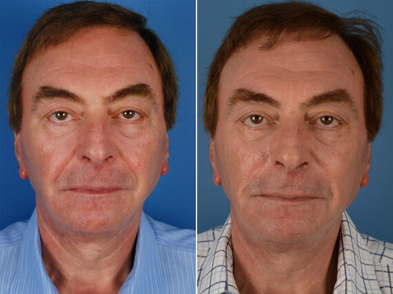 Excision of Nasolabial Folds Male Before and After Photos in Naples, FL, Patient 12012